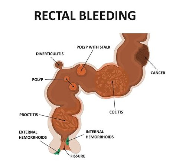 Can explosive diarrhea cause rectal bleeding?