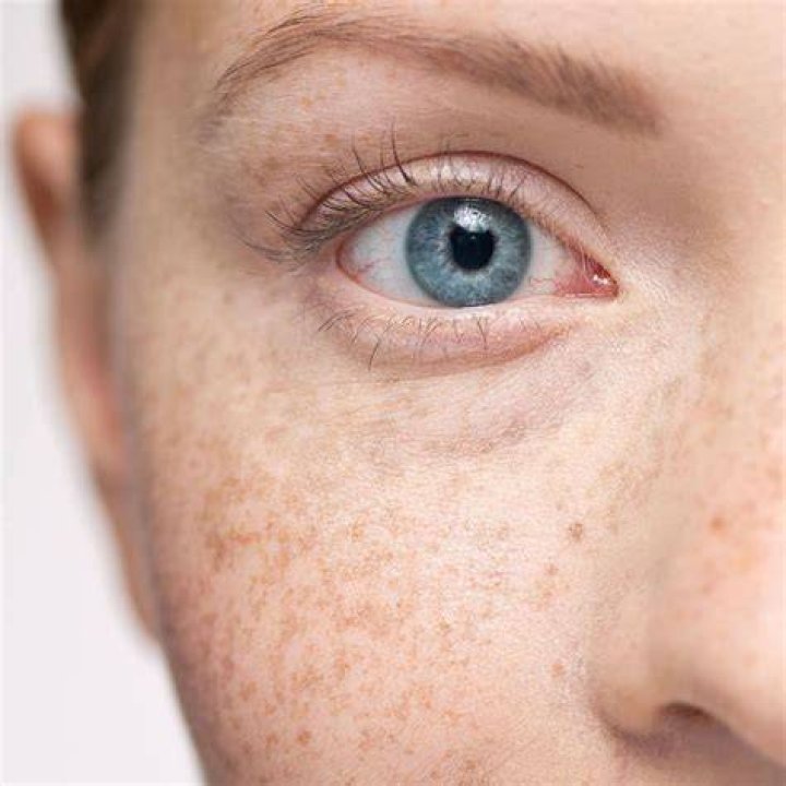 Could my baby have freckles?