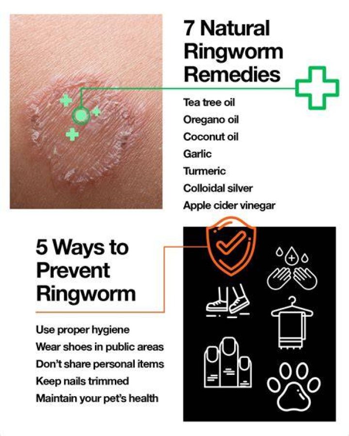 Do you get rid of ringworm?