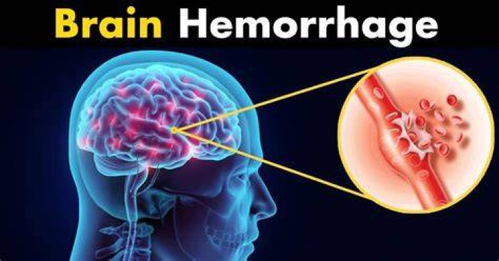 Does alcohol cause brain haemorrhage?