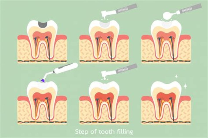 Does it pain after tooth filling?