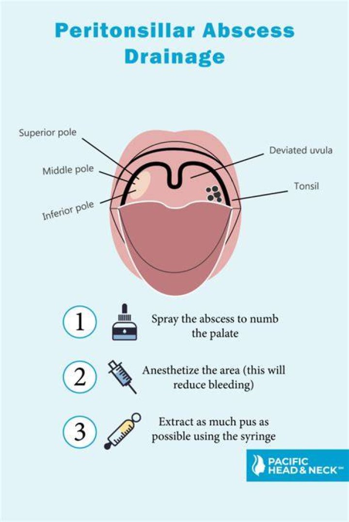 Does peritonsillar abscess drainage hurt?