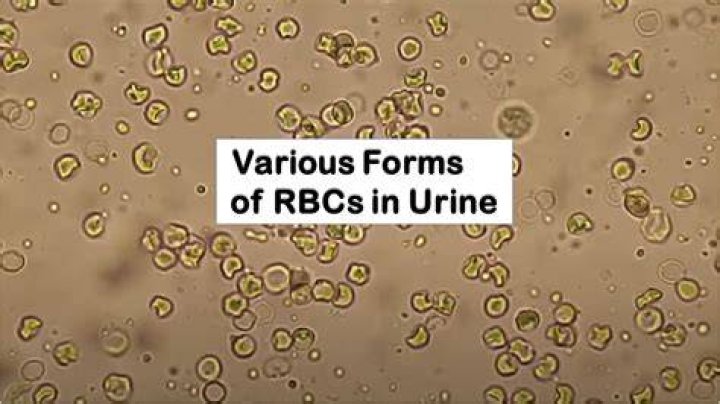 Should rbc be in urine?