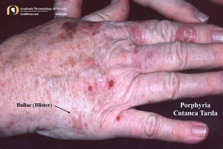 What is porphyria cutanea tarda?