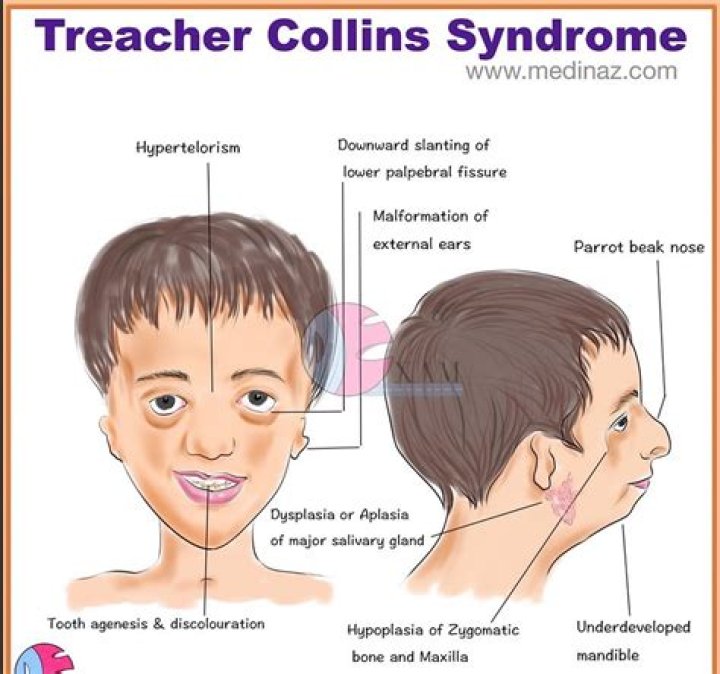When can treacher collins syndrome be detected?
