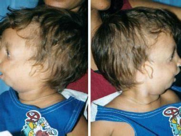 Who discovered mandibulofacial dysostosis?