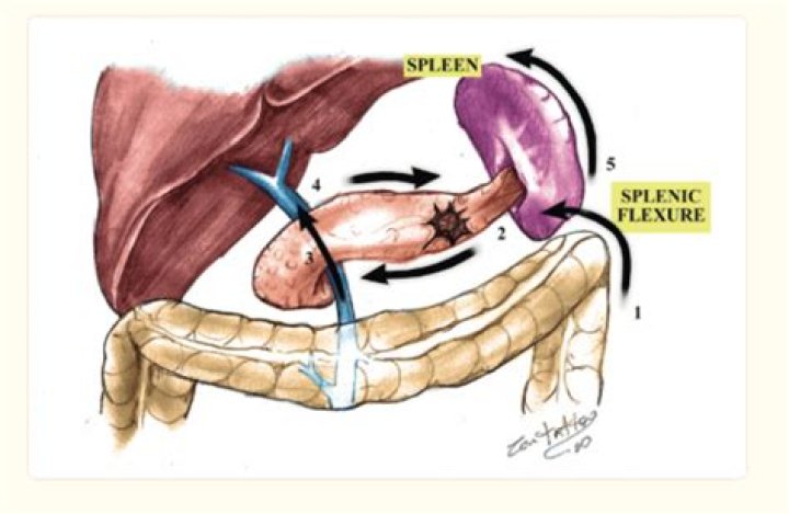 Why splenectomy with pancreatectomy?